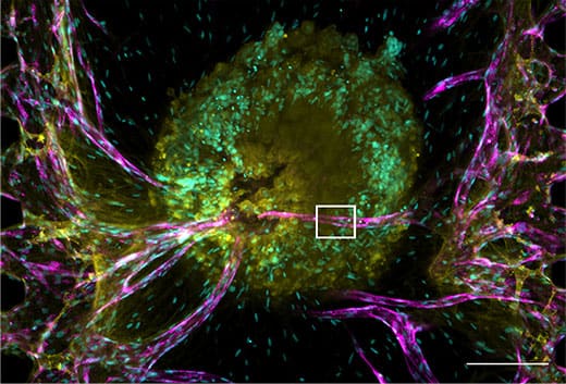 A cellular tumor spheroid and vascular network performed in a microfluidic device.